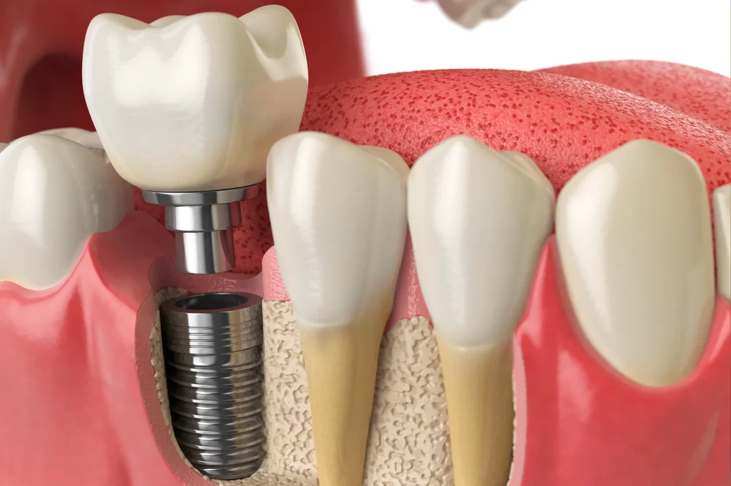 Implante Dentário CIPP odontologia São Carlos Dentista